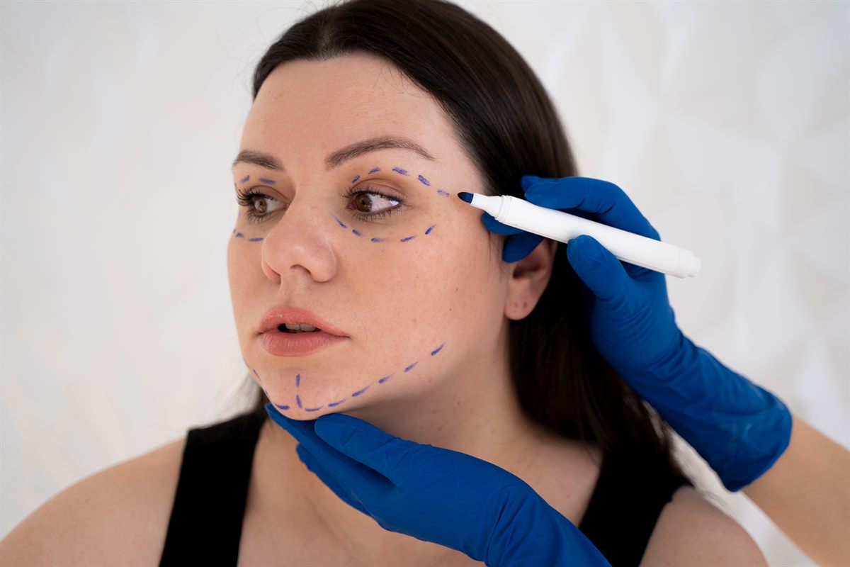 What Are Marionette Lines & How Does Filler Help?